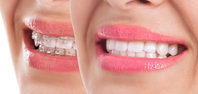 Chino Hills Orthodontic Braces