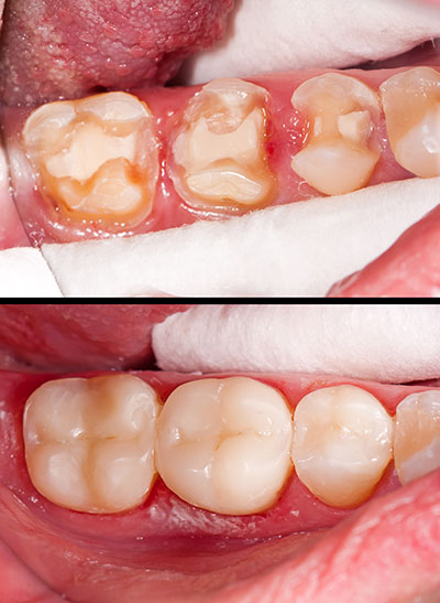 Composite Dental Fillings Chino Hills