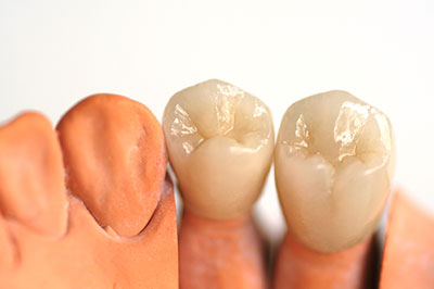 Dental Crowns in Chino Hills