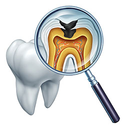 Treating Dental Decay 91709