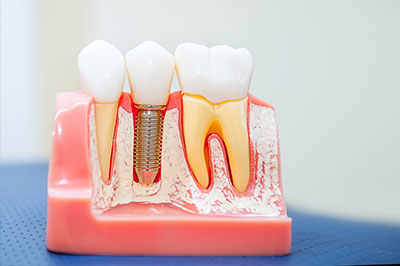 Dental Implants Chino Hills