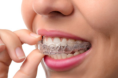 Invisalign 91709