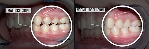 Malocclusion Chino Hills