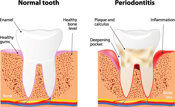 Chino Hills Periodontal Treatment