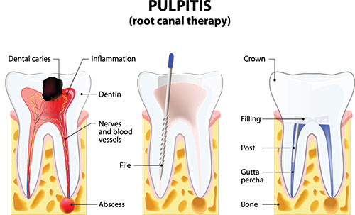 Root Canal Treatment in Chino Hills