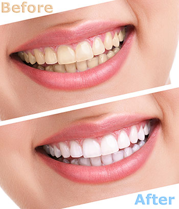 Teeth Whitening Dentist in Chino Hills