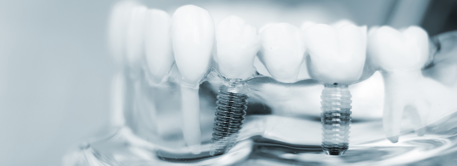 Chino Hills Dental Implants Dentist